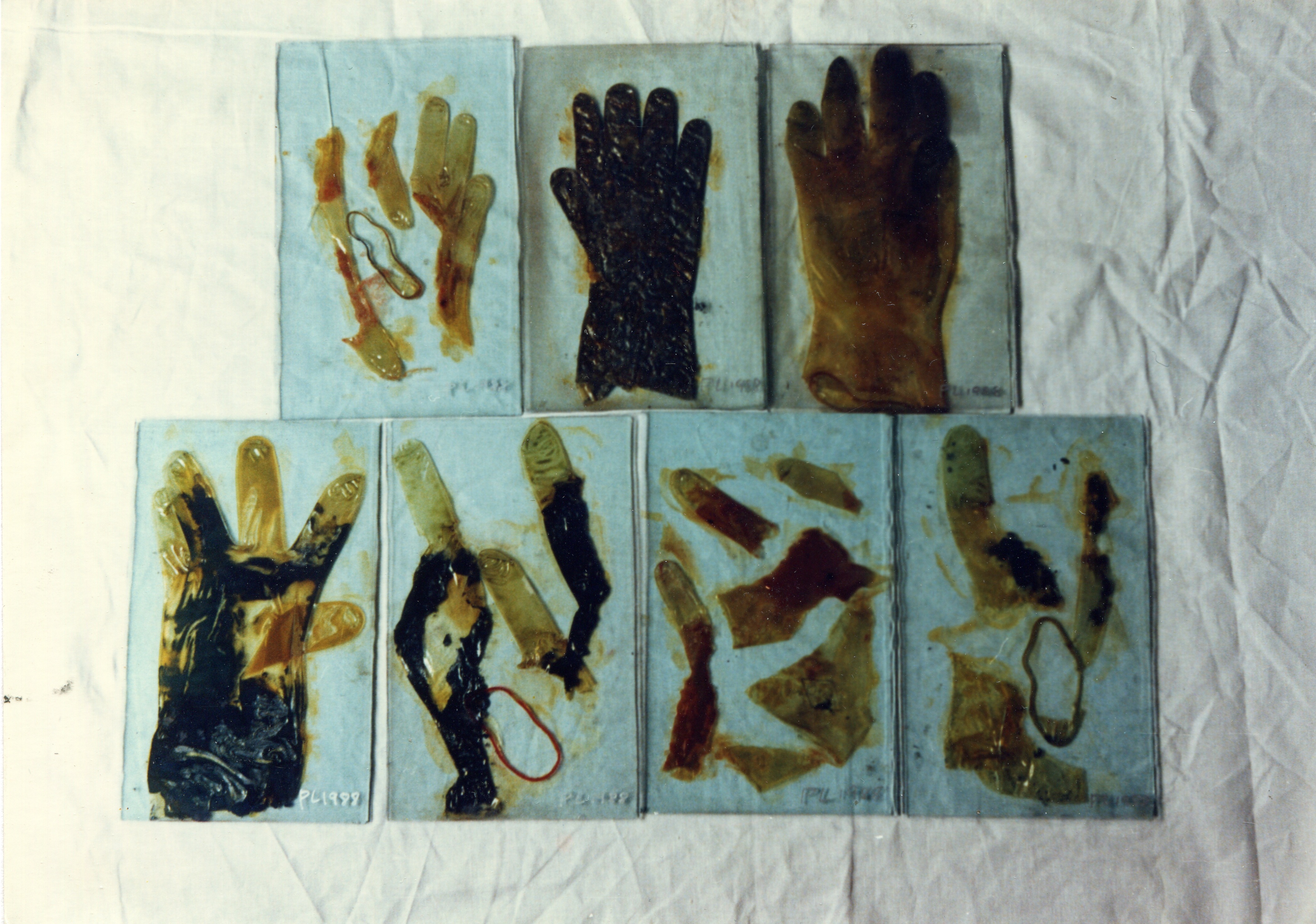 Collections Search A Report On The Hepatitis A Infection In 19 Set Of 1 Photograph And Photo Caption Asia Art Archive